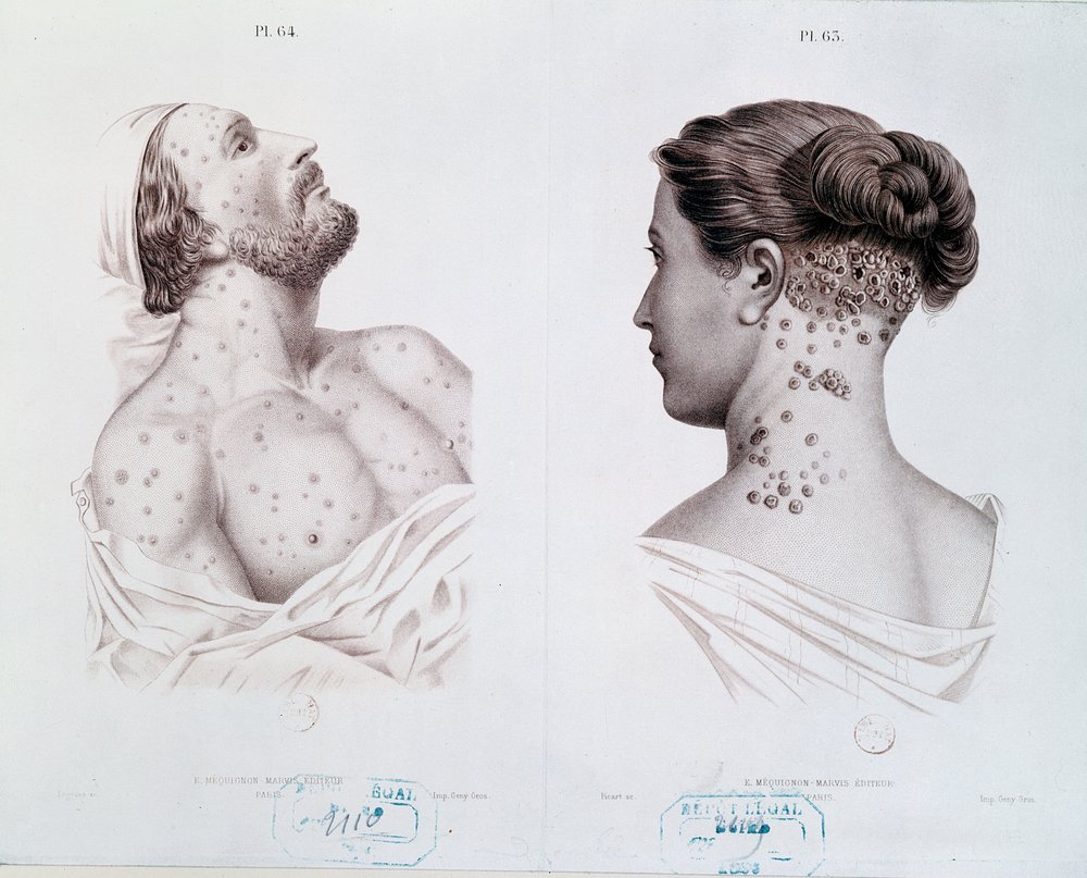 Syfilis-oireet miehillä ja naisilla, lääketieteellisestä kirjasta, n. 1850-60 tekijältä French School