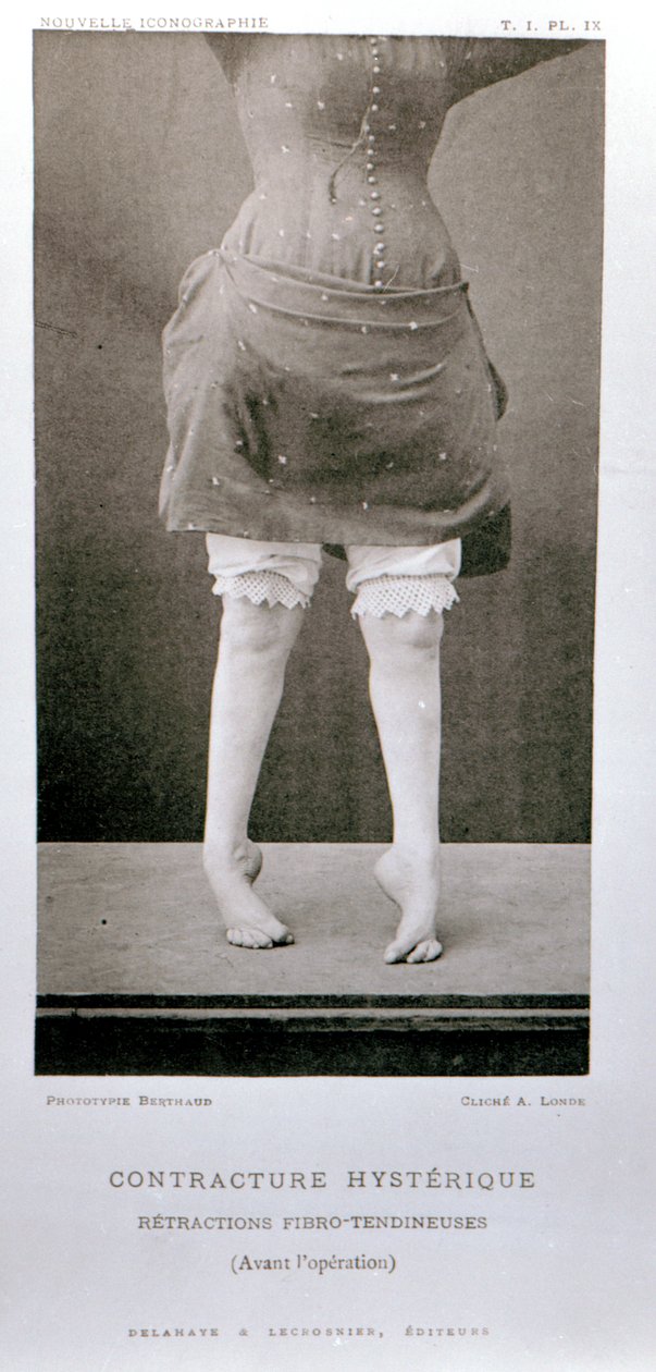 Tahaton kontraktuura, professori Jean Martin Charcotin (1825-1893) teoksesta Nouvelle Iconographie de la Salpetriere, julkaistu Pariisissa 1889 tekijältä Albert Londe