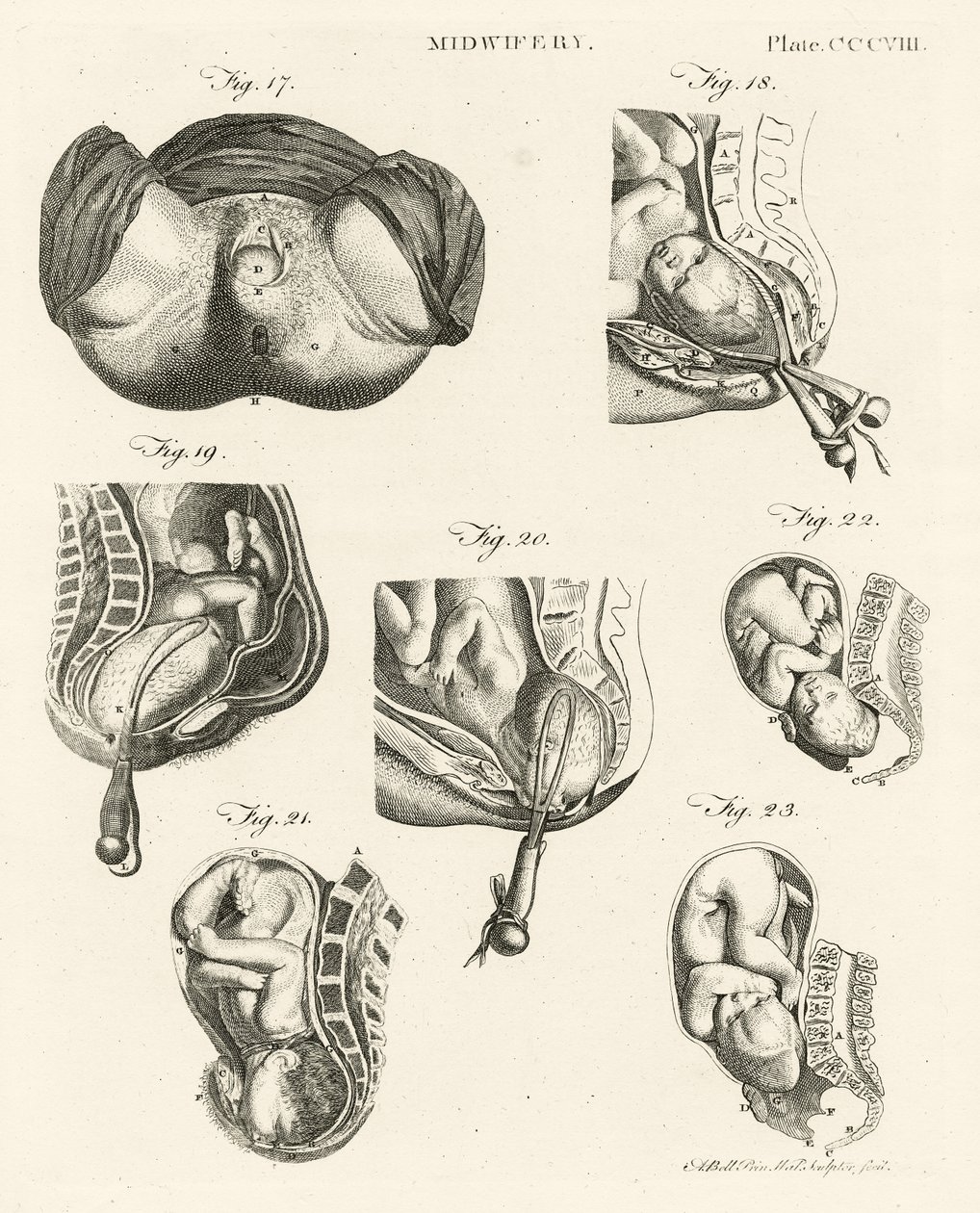 Kätilötyö, kuva "Encyclopedia Britannica", julkaistu Edinburghissa 1798 (kuparikaiverrus). tekijältä Alexander Bell