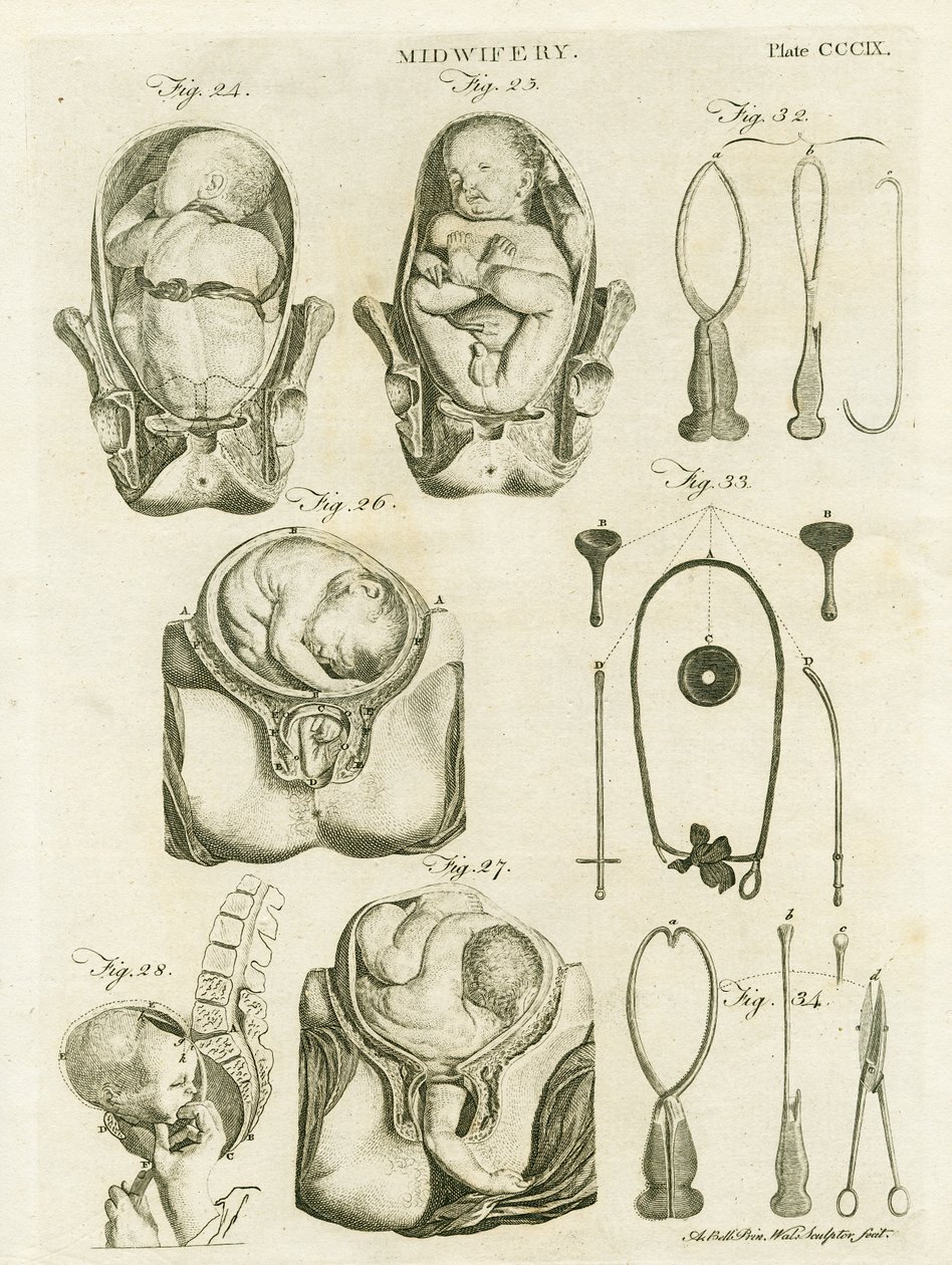 Kätilötyö, kuva "Encyclopedia Britannica", julkaistu Edinburghissa 1798 (kuparikaiverrus). tekijältä Alexander Bell