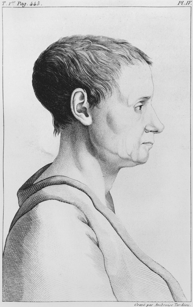 Theroigne de Mericourt, kuvitus Etienne Esquirolin (1772-1840) levy IV, 1838 teoksesta "Des Maladies Mentales regardees sous le rapport medical, hygienique et medico-legal" tekijältä Ambroise Tardieu