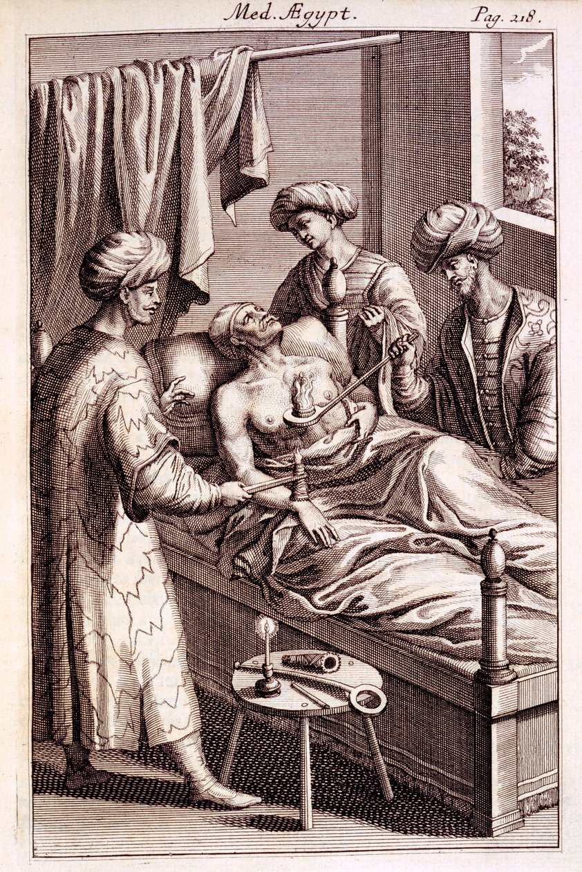 Prospero Alpinuksen kuva moksibustiosta Medicina Aegyptorumista, 1745 tekijältä American School