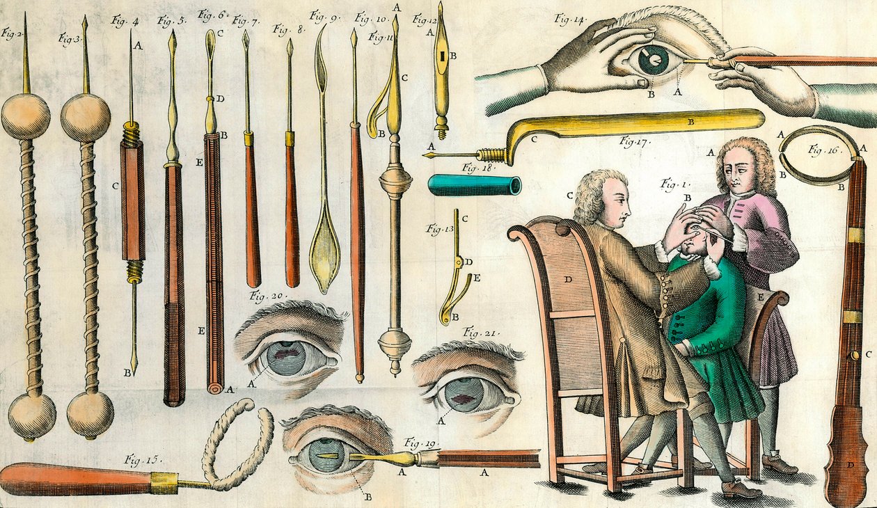 Kirurgia 1700-luvulla: silmäleikkaus. Instrumentit kaihileikkaukseen ja tekopupillin muodostukseen. Kaiverrus Lorenz Heisterin kirjaan "Institutions chirurgicale". tekijältä Anonymous Anonymous