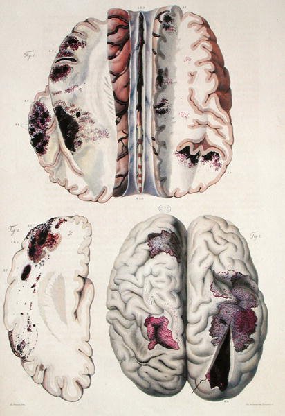 Kapillaarinen apopleksia, Jean Cruveilhierin (1791-1874) teoksesta "Anatomie Pathologique du Corps Humain" 1828-42 (värinen kaiverrus) tekijältä Antoine Chazal