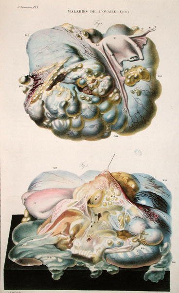 Munasarjojen sairaudet, Jean Cruveilhierin (1791-1874) julkaisusta "Anatomie Pathologique du Corps Humain", 1828-42 (värinen kaiverrus) tekijältä Antoine Chazal