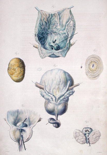 Virtsarakon ja eturauhasen sairaudet Jean Cruveilhierin (1791-1874) julkaisusta "Anatomie Pathologique du Corps Humain", 1828-42 (värinen kaiverrus) tekijältä Antoine Chazal