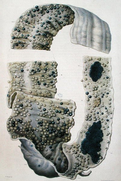 Suolisairaudet, Jean Cruveilhierin (1791-1874) julkaisusta "Anatomie Pathologique du Corps Humain", 1828-42 (värinen kaiverrus) tekijältä Antoine Chazal