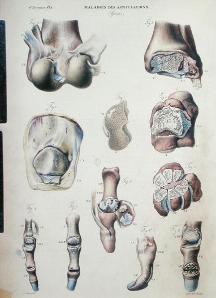 Nivelsairaudet, Jean Cruveilhierin (1791-1874) julkaisusta "Anatomie Pathologique du Corps Humain" 1828-42 (värinen kaiverrus) tekijältä Antoine Chazal