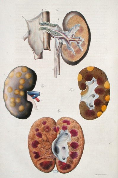 Munuaissairaudet, Jean Cruveilhierin (1791-1874) julkaisusta Anatomie Pathologique du Corps Humain 1828-42 (värinen kaiverrus) tekijältä Antoine Chazal