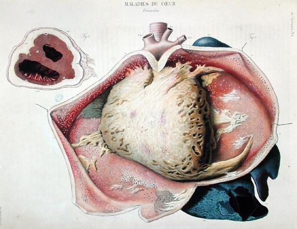 Perikardiitti, levy, joka kuvaa sydänsairauksia Jean Cruveilhierin (1791-1874) Anatomie pathologique du corps humainesta, julkaistiin Pariisissa tekijältä Antoine Chazal