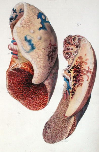 Keuhkokuume, Jean Cruveilhierin (1791-1874) teoksesta "Anatomie Pathologique du Corps Humain" 1828-42 (värinen kaiverrus) tekijältä Antoine Chazal