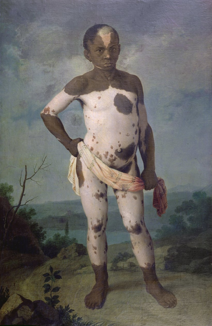 Lapsi, jolla on vitiligo, 1786 tekijältä Brazilian School