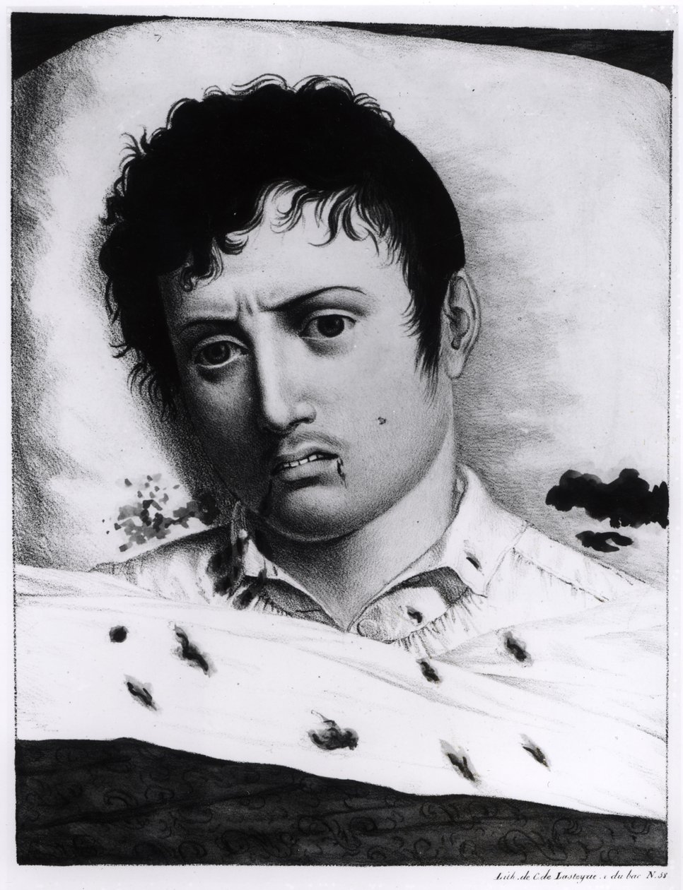 Keltakuumeen havainnointi, n. 1819 tekijältä Charles Lasteyrie du Saillant