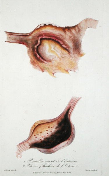 Pehmenevät ja follikulaariset mahahaavat, "Traite des Maladies des Enfans Nouveaux-Nes et a la Mamelle", Charles-Michel Billard, kaiverrus Stassel tekijältä Charles Michel (after) Billard
