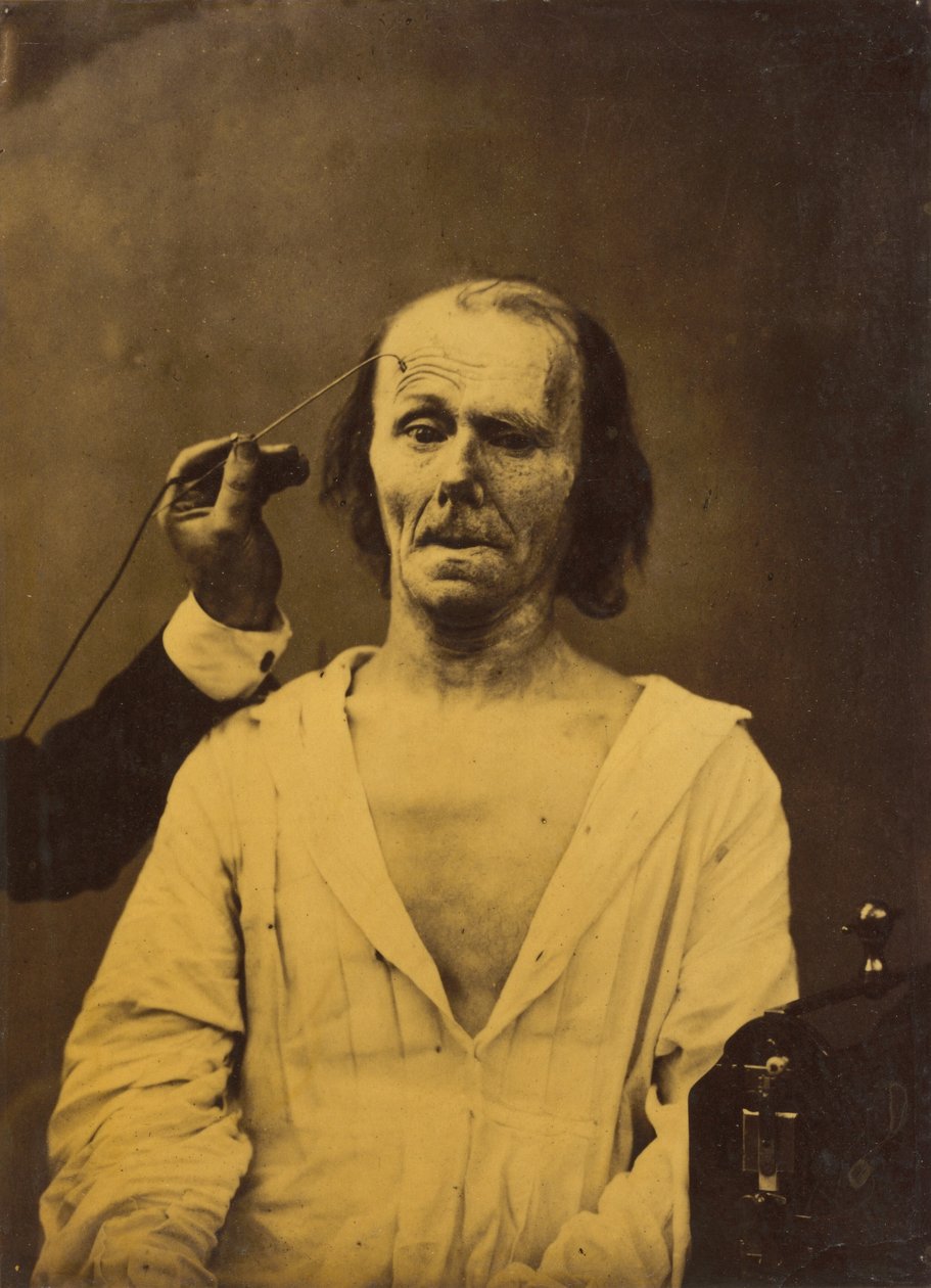 Rentoutuneet kasvot vasemmalla, syvällinen huomio oikealla, 1854-1856, painettu 1862. tekijältä Duchenne de Boulogne