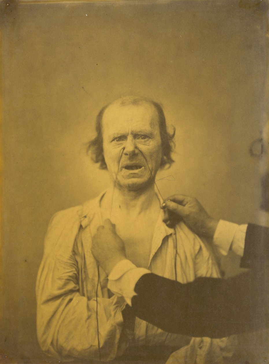Tyytymättömyys, huono huumori, 1854-1856, painettu 1862. tekijältä Duchenne de Boulogne
