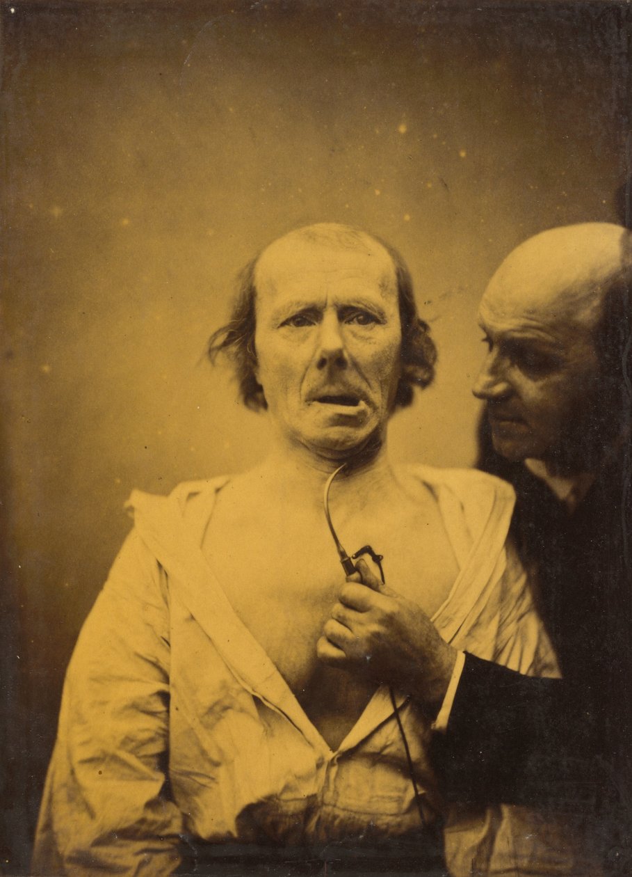 Tämä supistuminen m. Pelkästään platysmasta puuttuu ilmaisu, 1854-1856, painettu 1862. tekijältä Duchenne de Boulogne