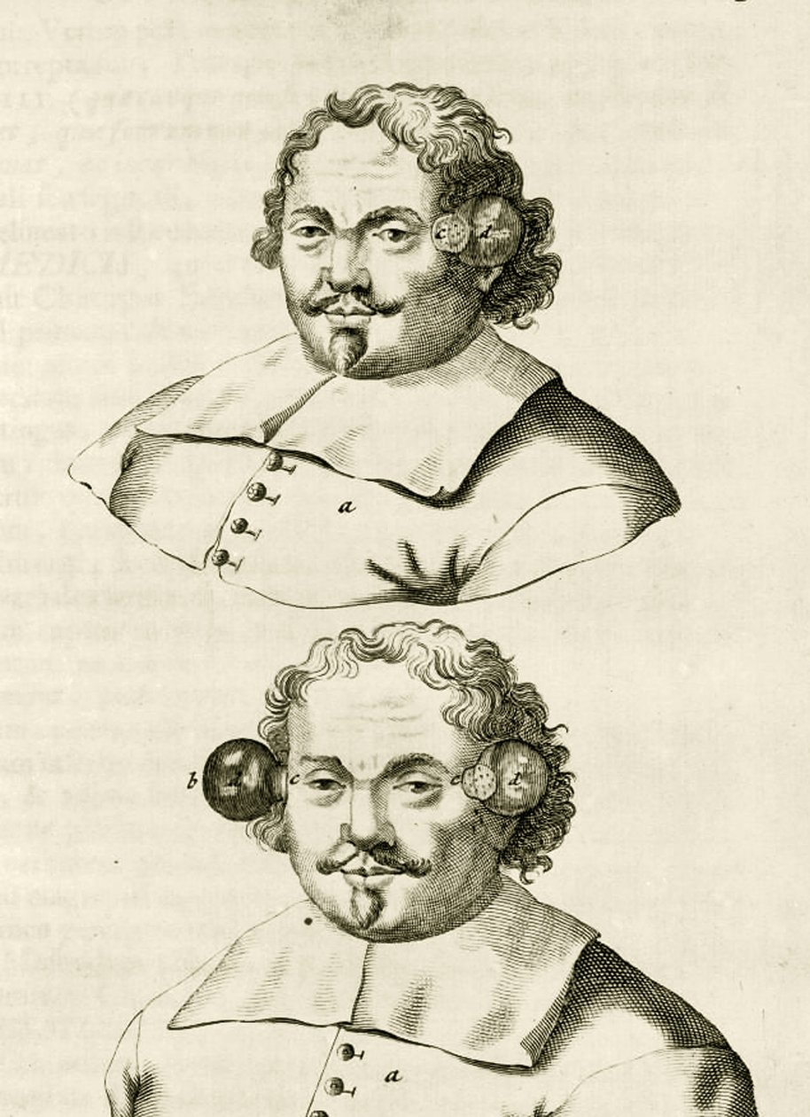 Esimerkki kuppauksesta, Frederik Dekkerin teoksesta The Practice of Medicine, 1694 tekijältä Dutch School