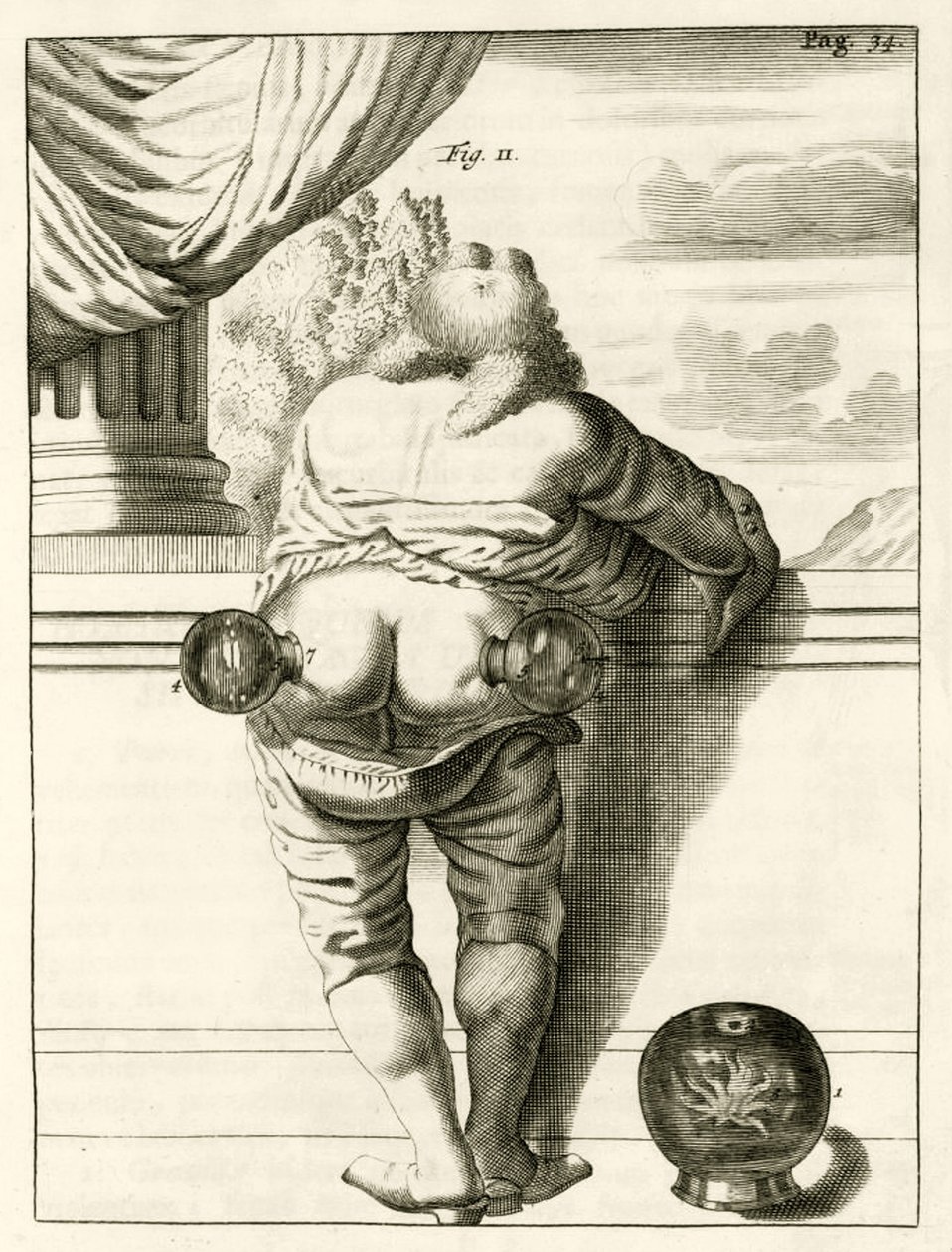 Esimerkki kuppauksesta, Frederik Dekkerin teoksesta The Practice of Medicine, 1694 tekijältä Dutch School