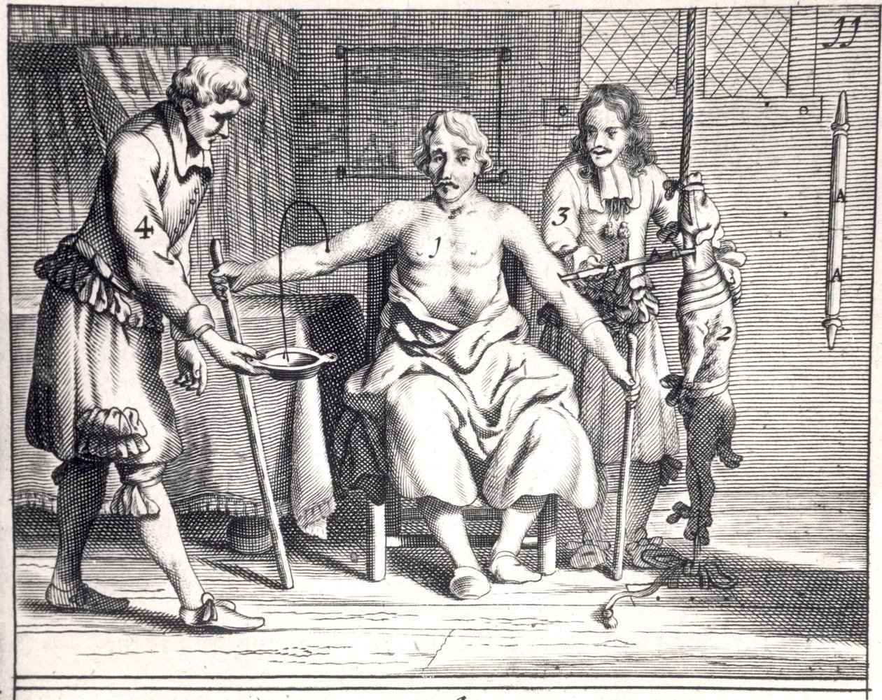 Verensiirto koirasta, Johannes Schultesin (1595-1645) Armamentarii Chirurgici, julkaistu Amsterdamissa, 1671 tekijältä Dutch School
