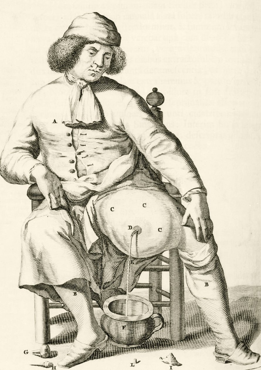 Frederik Dekkers, 1694, nesteen tyhjennys paiseesta tekijältä Dutch School