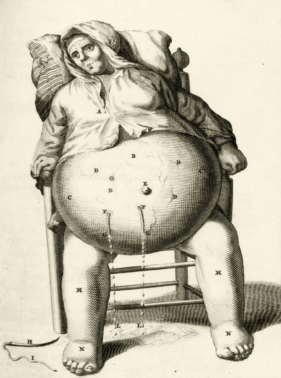Nesteiden tyhjennys paiseesta, Frederik Dekkers, 1694 tekijältä Dutch School