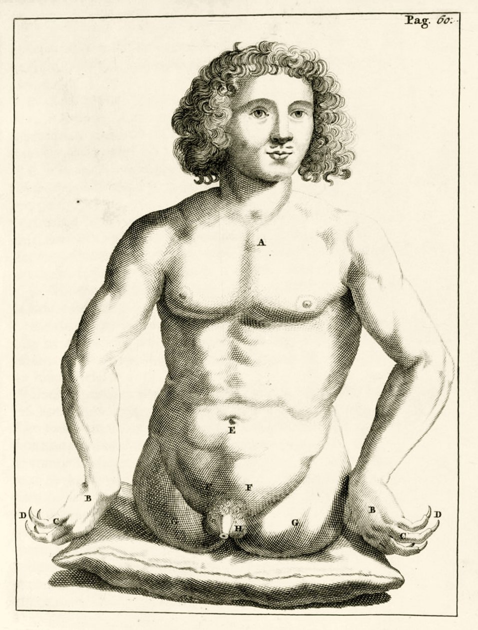 Frederik Dekkers, 1694, esimerkki synnynnäisistä epämuodostumista tekijältä Dutch School