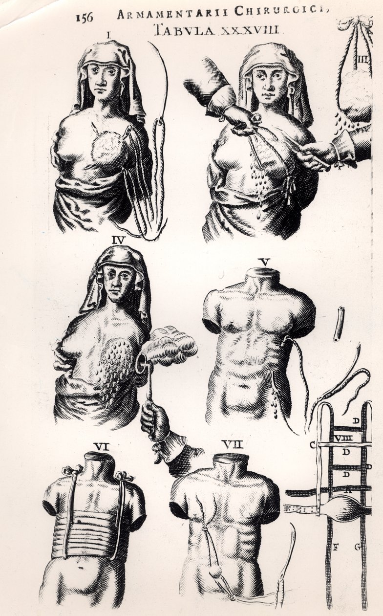 Rintasyövän leikkaus, Johannes Schultesin (1595-1645) Armamentarii Chirurgici, julkaistu Amsterdamissa, 1672 tekijältä Dutch School