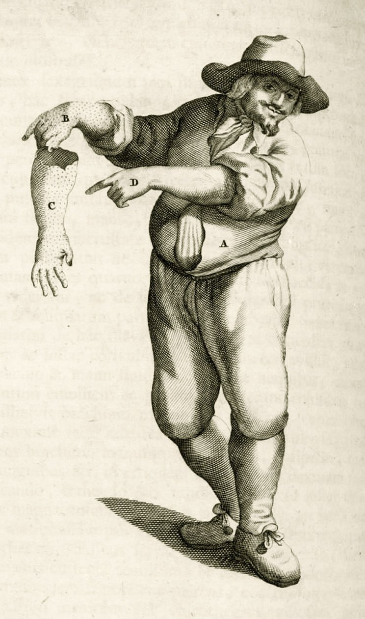 Kuolleen ihon poistaminen märkärakkuloilla, Frederik Dekkersin käytännön harjoituksista lääketieteellisissä menetelmissä, 1694 tekijältä Dutch School