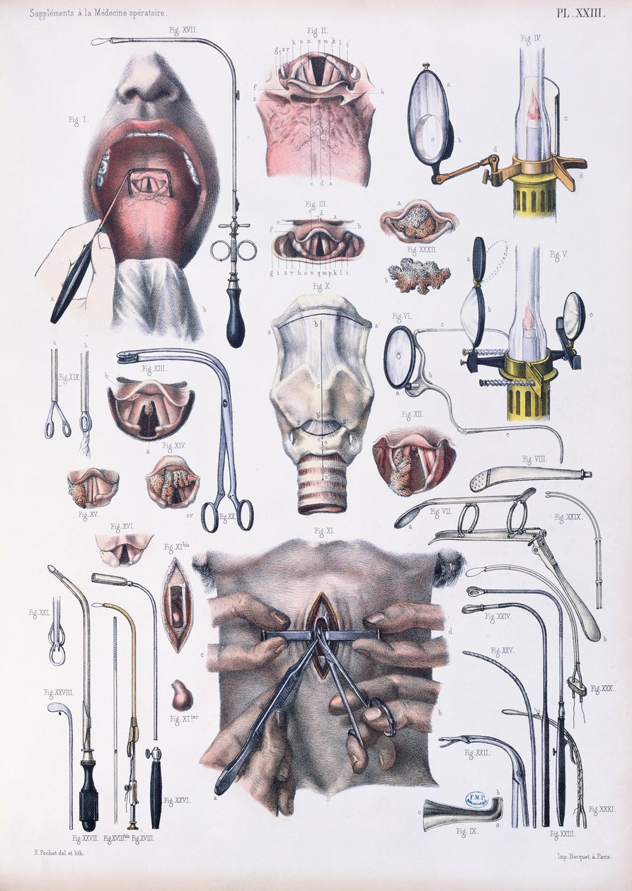 Trakeotomialeikkaus, levy Jean-Baptiste Marc Bourgeryn (1797-1849) Traite Complet de l
