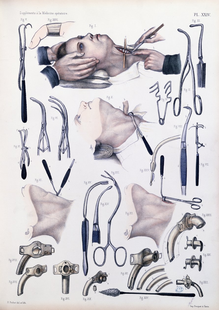 Trakeotomialeikkaus, levy Jean-Baptiste Marc Bourgeryn (1797-1849) Traite Complet de l