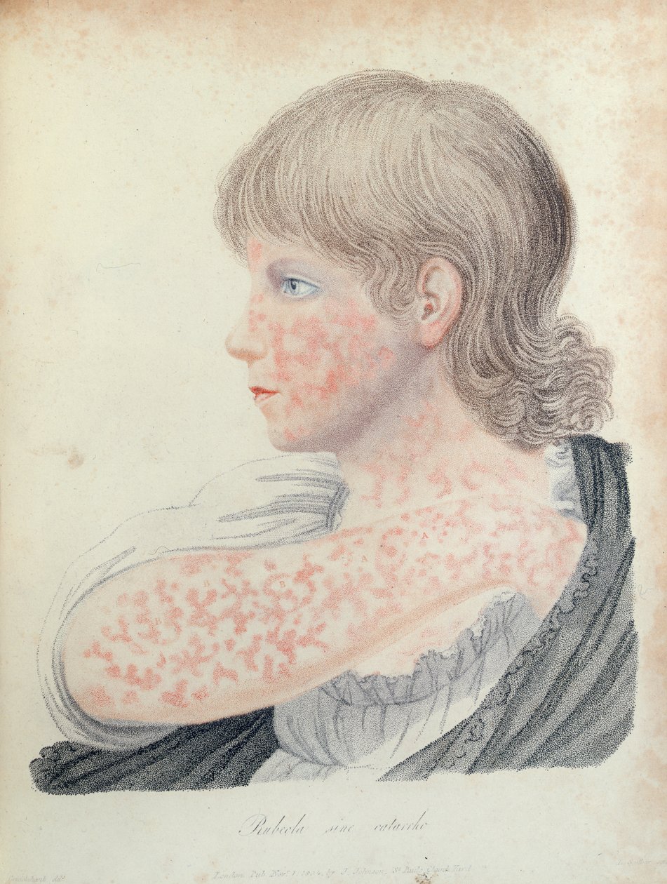Saksalainen tuhkarokko, kuvitus Robert Willanin (1757-1812) kirjaan, 1808 (värikaiverrus) tekijältä English School