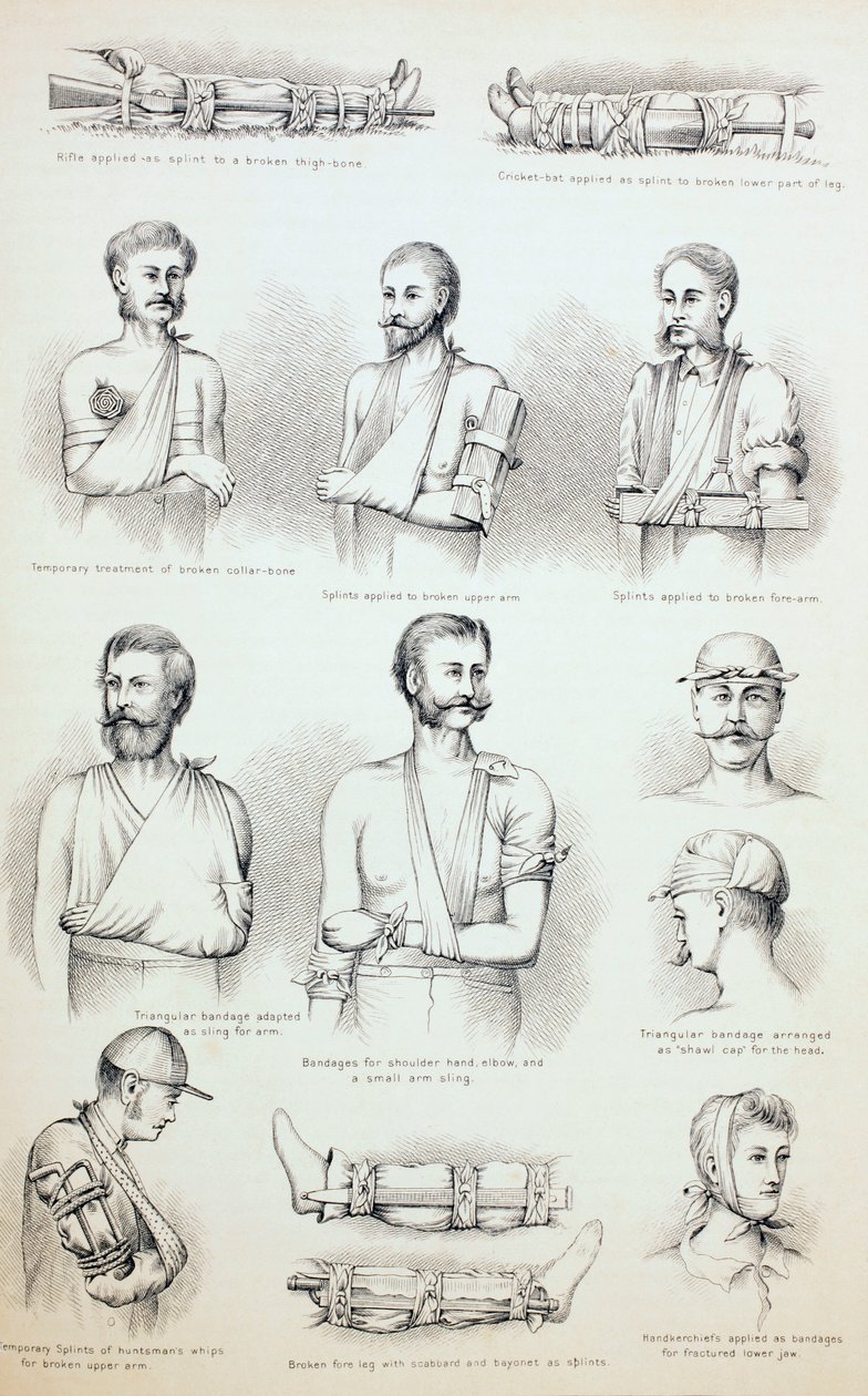 Murtumien väliaikainen hoito, n. 1890 tekijältä English School