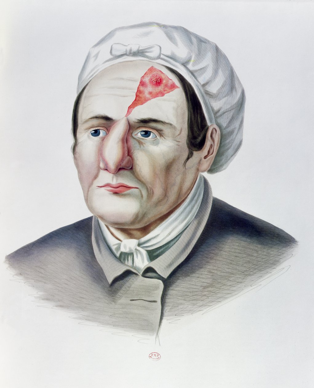 Ihonsiirtoleikkauksen jälkeen, Alexander Auvertin Selecta Praxis Medico-Chirurgica, Pariisi, 1856 tekijältä French School