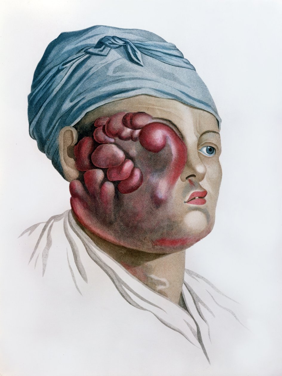 Syöpäskrofula, Baron Jean Louis Alibertin (1768-1837) julkaisusta Description des Maladies de la Peau, Pariisi, 1806 tekijältä French School
