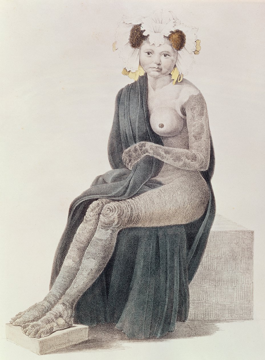 Synnynnäinen ikthyoosi, kirjasta G.M. Olbers, 1830 tekijältä French School