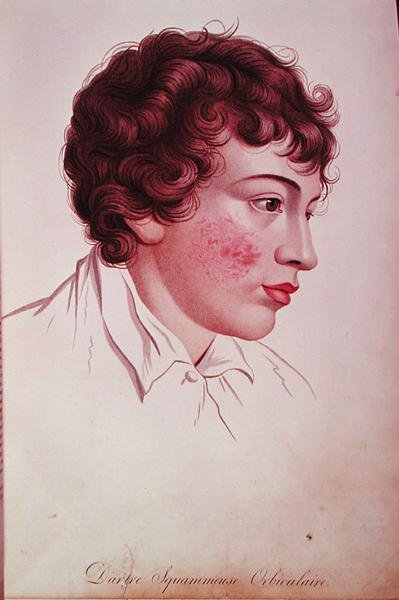 Kuiva laastari, paroni Jean Louis Alibertin (1768-1837) kirjasta Description des Maladies de la Peau. tekijältä French School