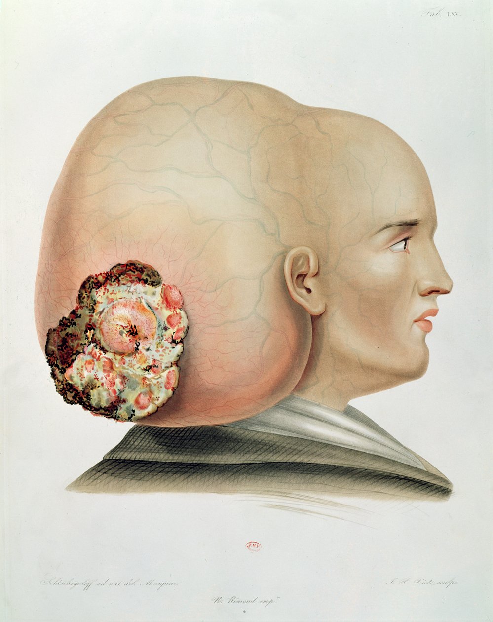 Dura materin sieni, Alexander Auvertin Selecta Praxis Medico-Chirurgica, Pariisi, 1856 tekijältä French School