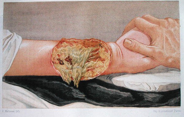 Hospital Gangrene, "Traite de Chirurgie de Guerre", Edmund Delorme (1847-1929), kaiverrus F. Meheux tekijältä French School