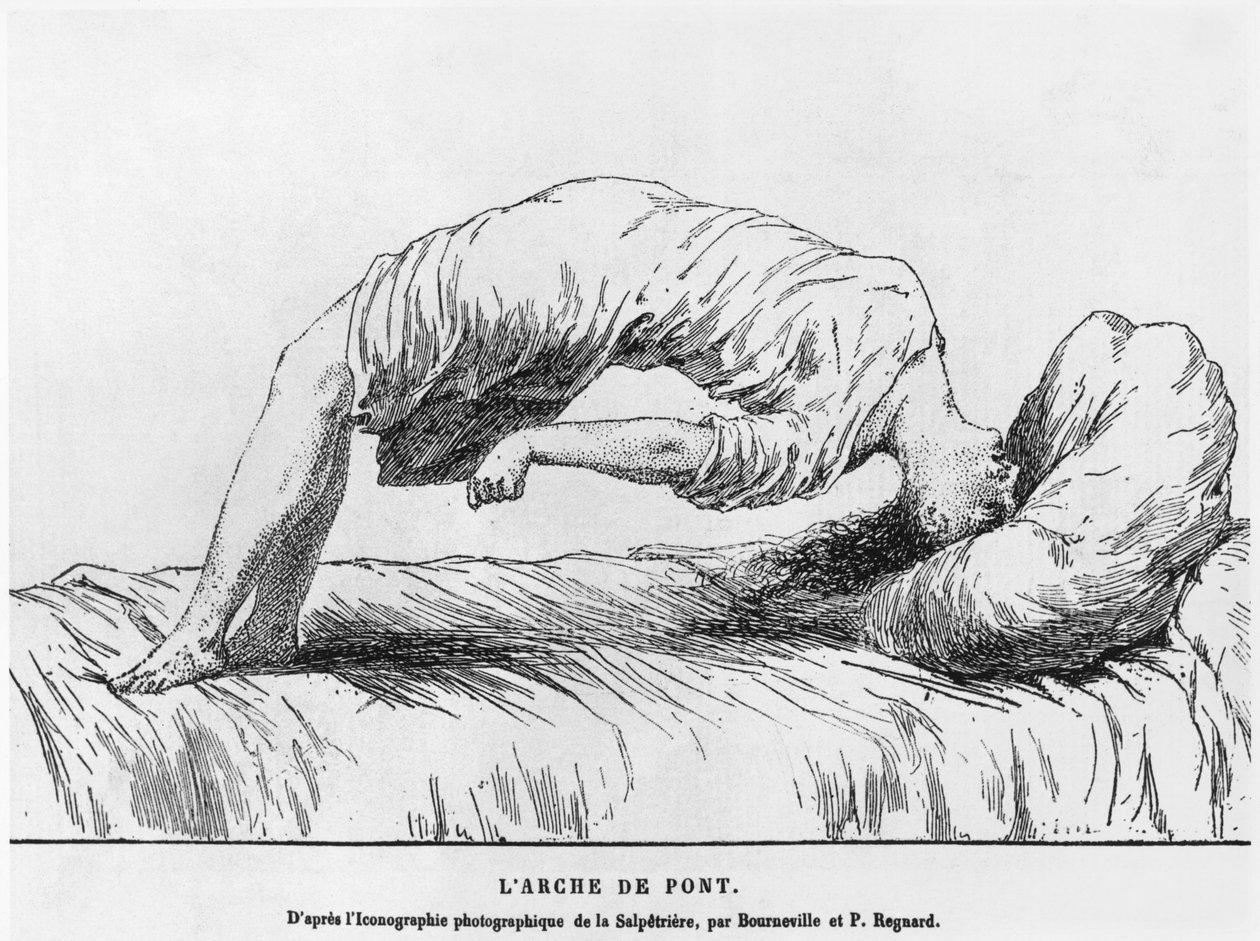 Hysteria ja somnambulismi, Paul Regnardin (1850-1927) Les Maladies Epidemiques de lEsprit -teoksesta 1884 tekijältä French School