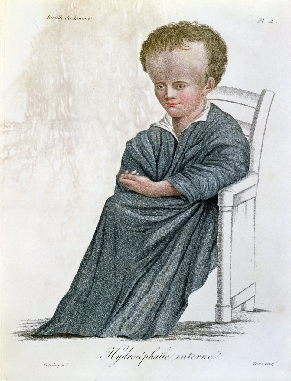 Sisäinen vesipää, Nosologie Naturelle, Baron Jean Louis Alibert (1768-1837), kaiverrus Tresca, 1817 tekijältä French School