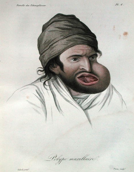 Leuan polyyppi, paroni Jean Louis Alibertin (1768-1837) kirjasta 1817 (värillinen kaiverrus) tekijältä French School