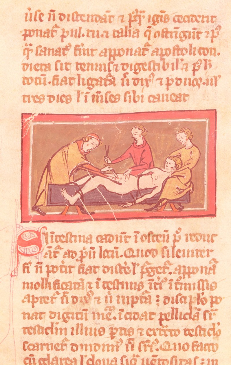 Ms H 89 fol.23 Surgery, Rogier de Salernen kirjan Book of Surgery painoksesta tekijältä French School