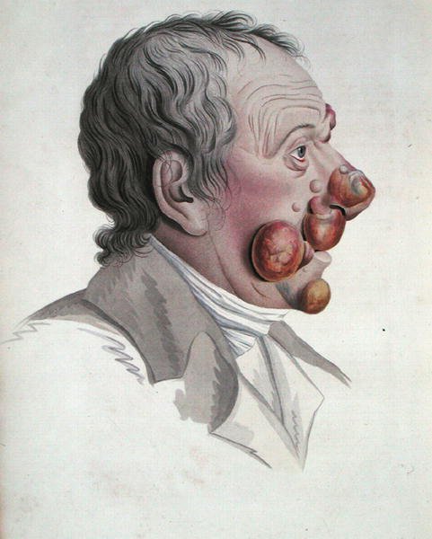Mycosis Fongoide, Baron Jean Louis Alibertin (1768-1837) kirjasta 1838 (värillinen kaiverrus) tekijältä French School
