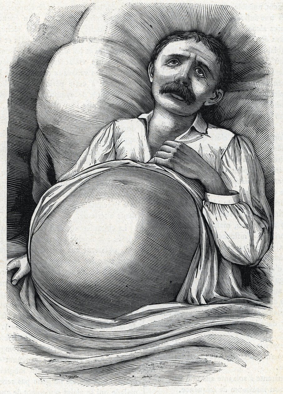 Potilas, jolla on pitkälle edennyt maksakirroosi (kaiverrus) 1888 tekijältä French School