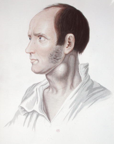 Potilas, jolla on aneurysma, Alexander Auvertin kirjasta 