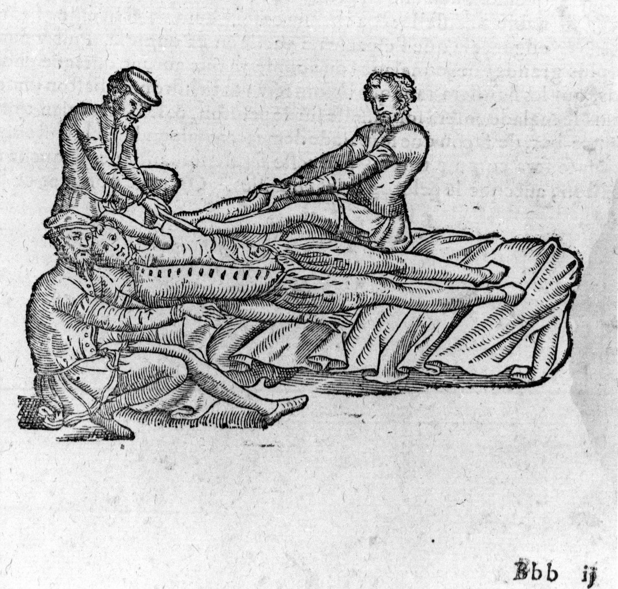 Dislokaation vähentäminen, "Ambroise Parén lääketieteellinen tutkielma", noin 1560. tekijältä French School