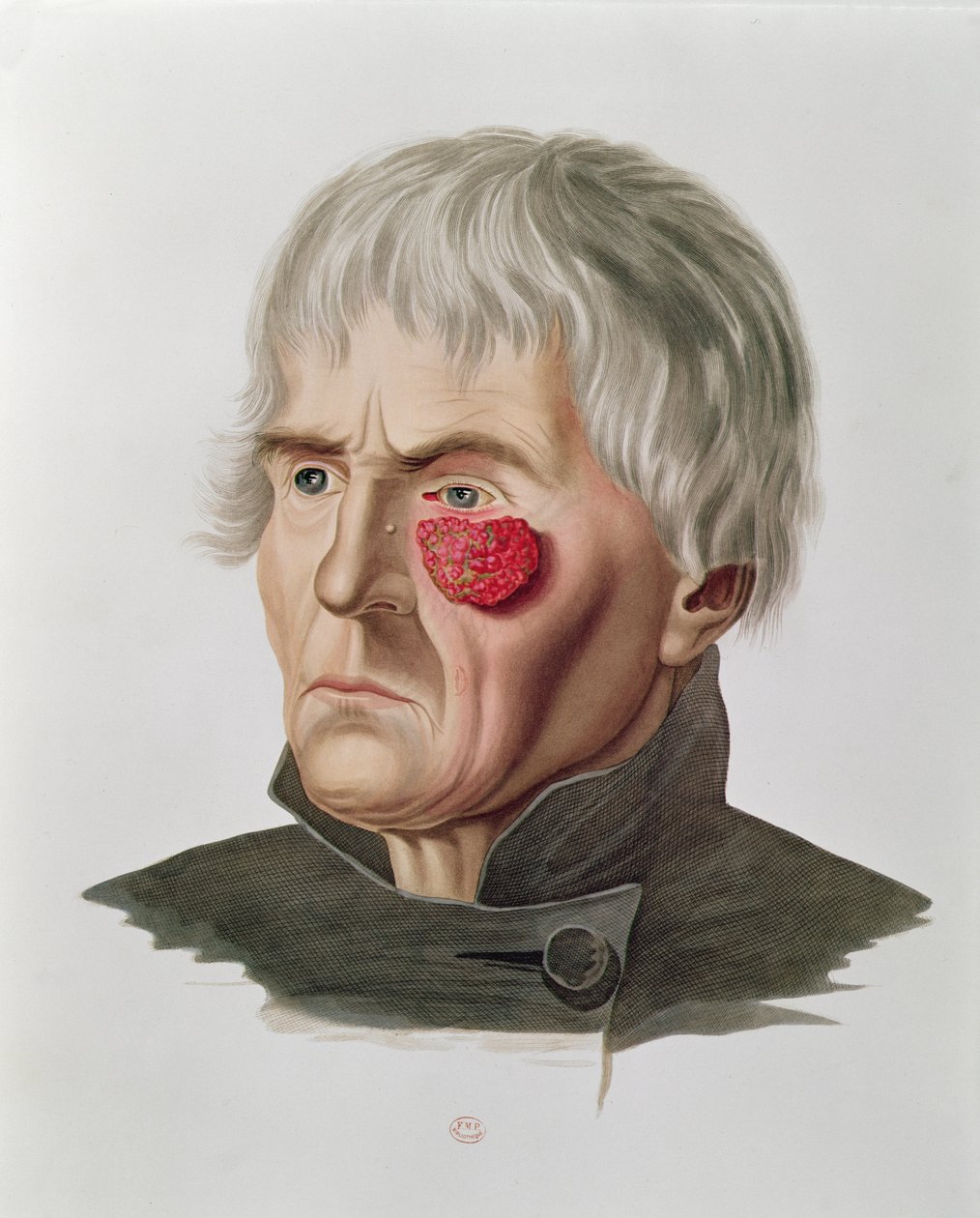 Ihosairaus ennen leikkausta, Alexander Auvertin Selecta Praxis Medico-Chirurgica, Pariisi, 1856 tekijältä French School