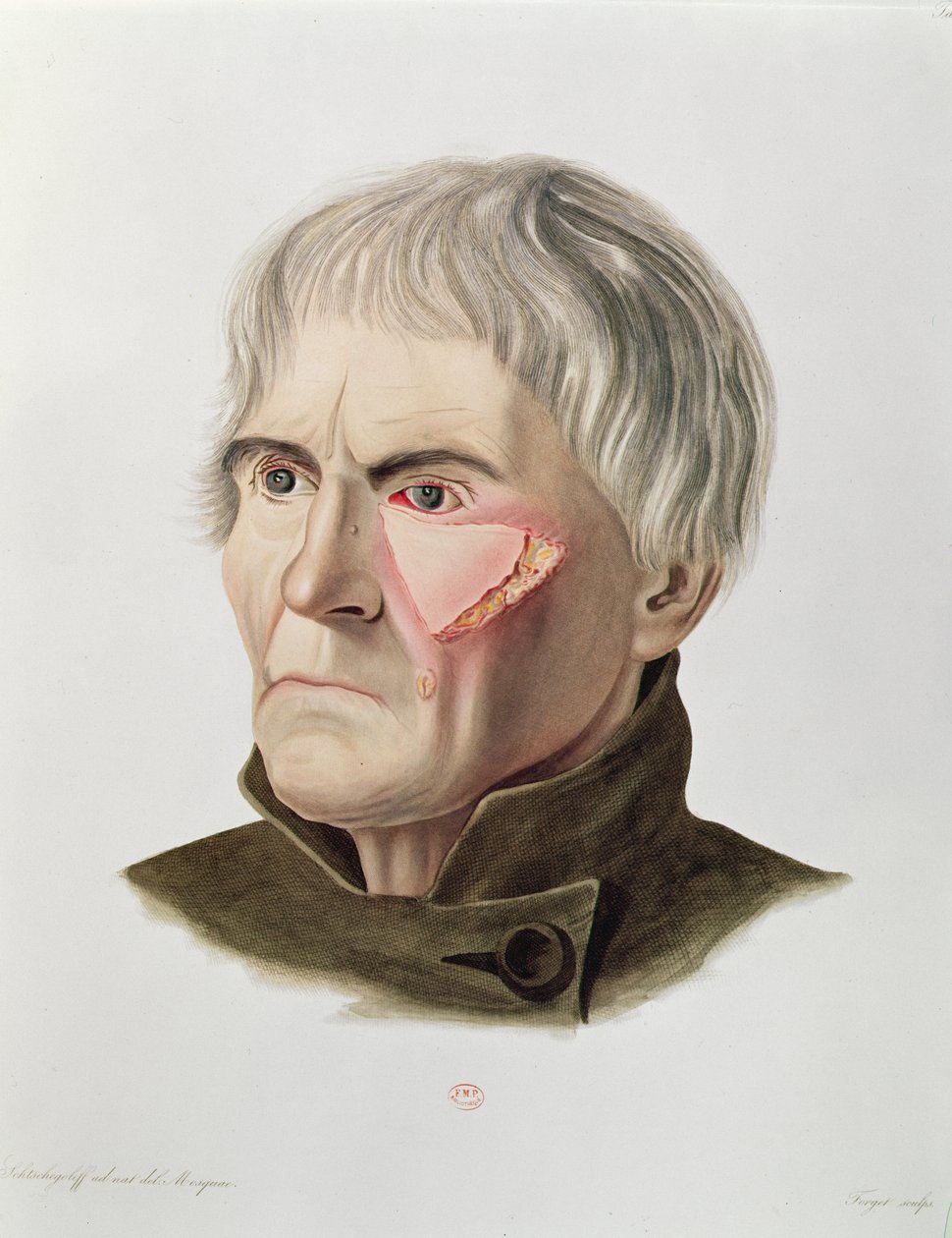Ihonsiirtoleikkaus, Alexander Auvertin Selecta Praxis Medico-Chirurgica, Pariisi, 1856 tekijältä French School
