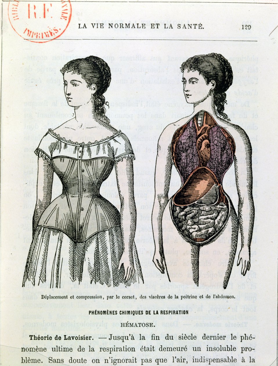 Korsetin haitalliset vaikutukset, kuvitus La Vie Normale et la Sante, tohtori Jules Rengade (s.1841) n. 1880 tekijältä French School